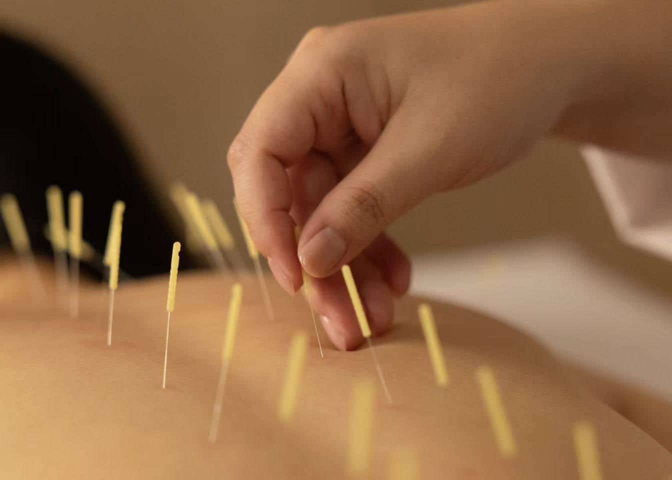 Acupuncture remains one of the traditional practices at the center of founder Sonia Guan’s approach to restorative wellness. Photo courtesy of Innate Beauty Concepts.